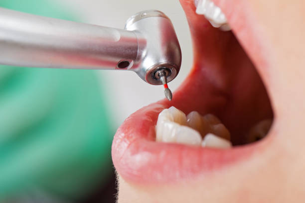 Best Lost Filling or Crown Replacement in Shady Hollow, TX